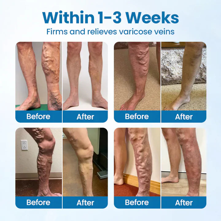 đ ODEIUN⢠VeinGuard Herbal Spray â â
Clinically Proven to Erase Varicose Veins in Just 7 Days!