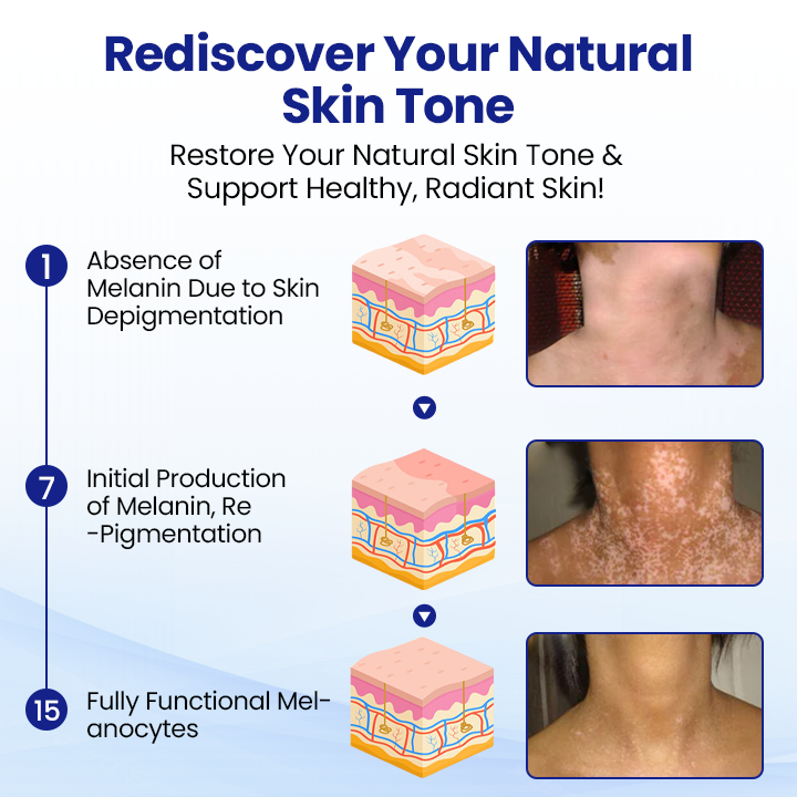 ODEIUN™ Vitiligo Treatment Spray 🌿 Fade Spots Restore Confidence 🌞