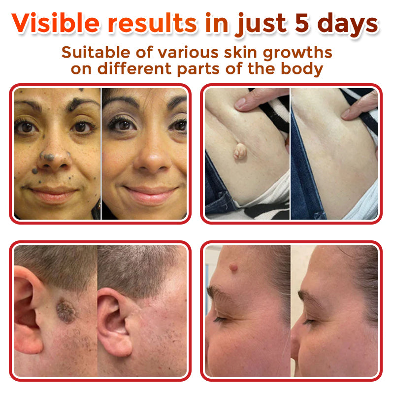 ✅Negusy™ MicroNeedle Botanic Skin Tag Removal Patches – 🇺🇸 Made in the USA | Fast, Painless, Plant-Powered