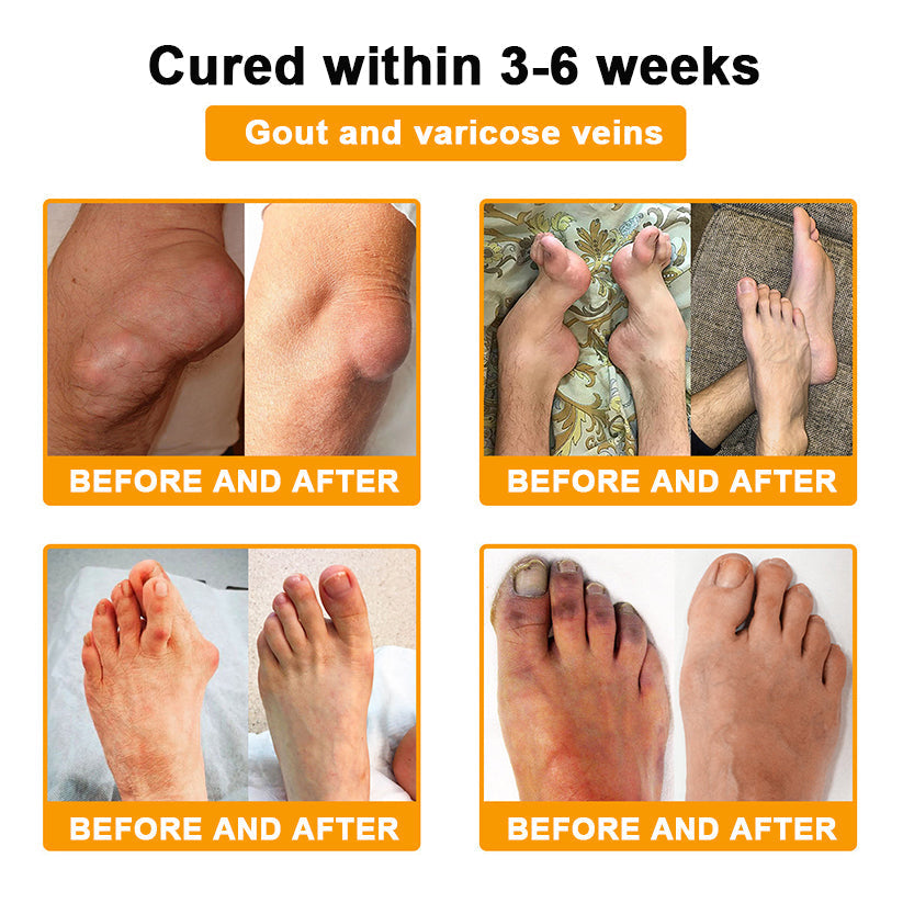 đFlash Sale - Seurico⢠Botulinum Toxin & Bee Venom Pain-Relief Bone Healing Cream