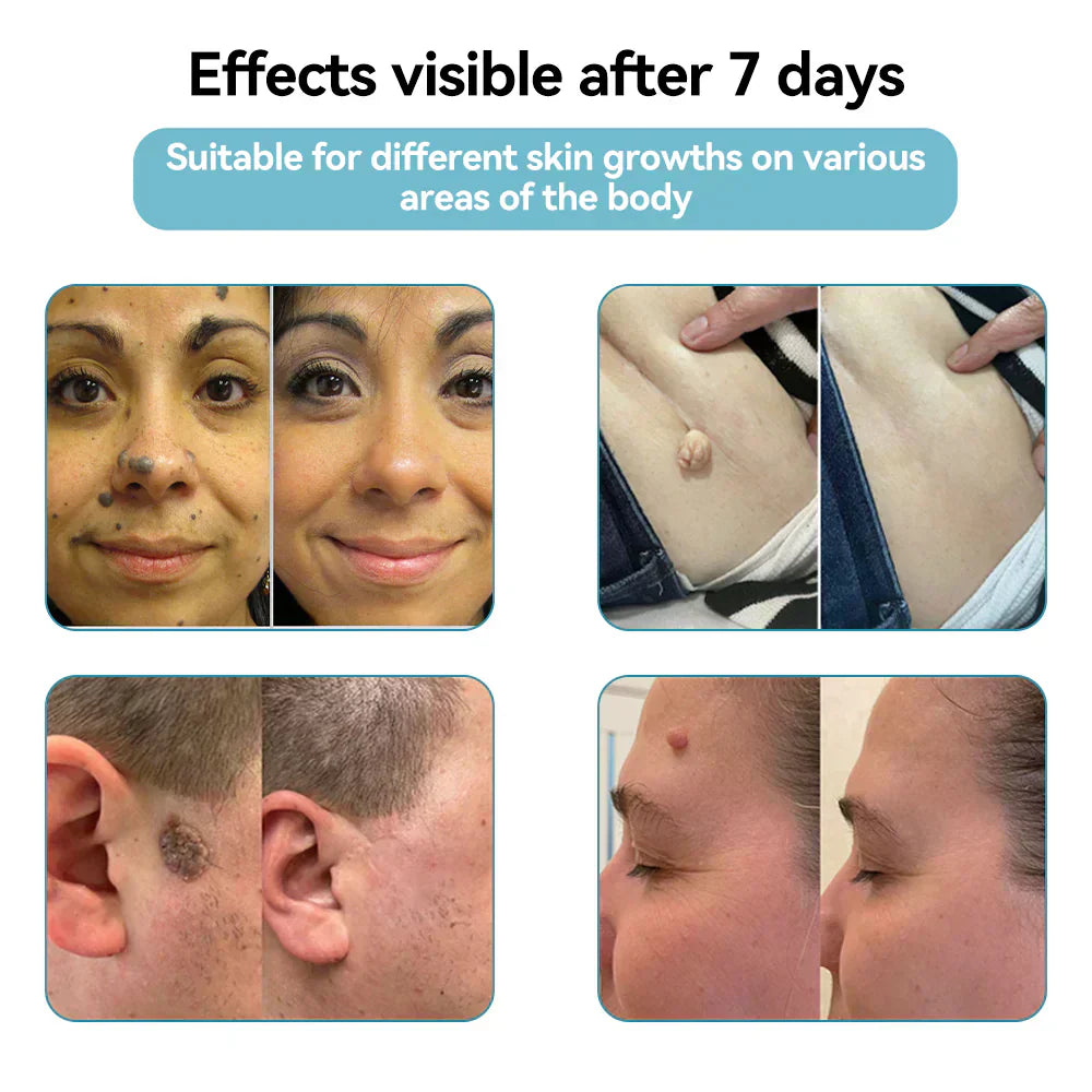 Seurico™ VelvetSkin+ Laser Eraser Pen | Non-Invasive Removal for Moles & Warts
