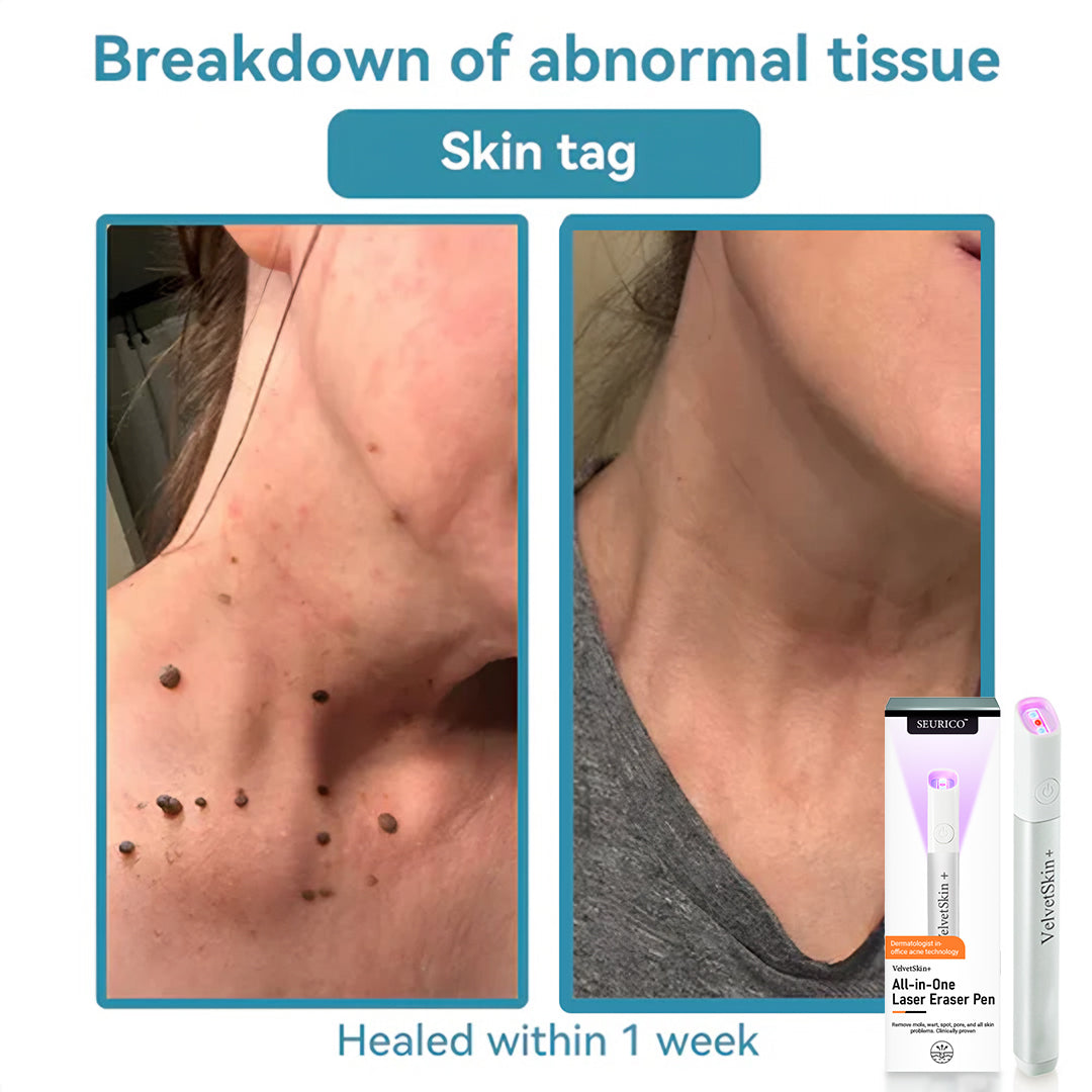 Seurico™ VelvetSkin+ Laser Eraser Pen | Non-Invasive Removal for Moles & Warts