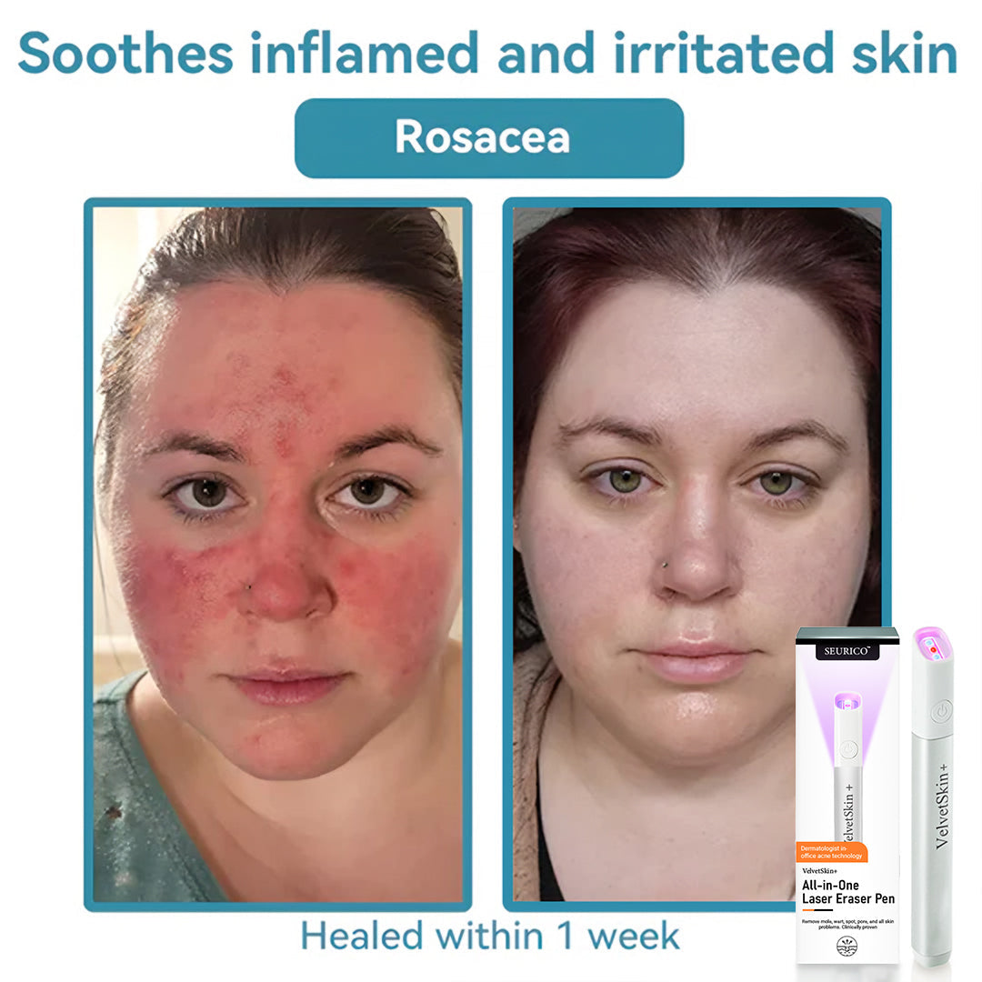 Seurico™ VelvetSkin+ Laser Eraser Pen | Non-Invasive Removal for Moles & Warts