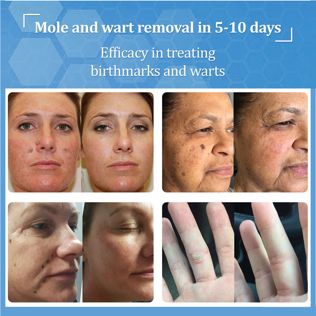 đŠââď¸LBMLBM⢠BeeDerm RX Cream, Painless, easy and gentle fix for warts, skin tags, lumps, infections, cysts and scars