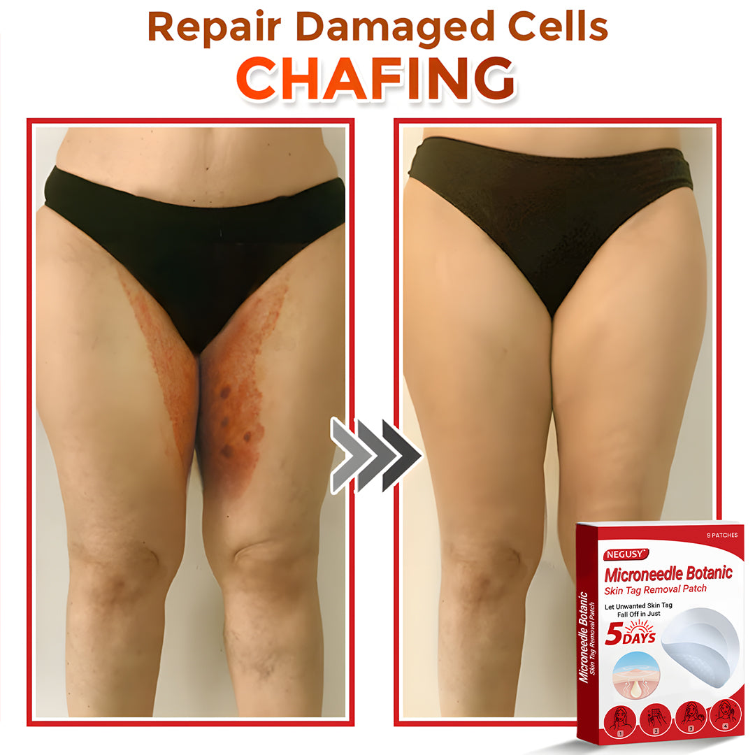 Negusy™ MicroNeedle Botanic Skin Tag Removal Patches – 🇺🇸 Made in the USA | Fast, Painless, Plant-Powered