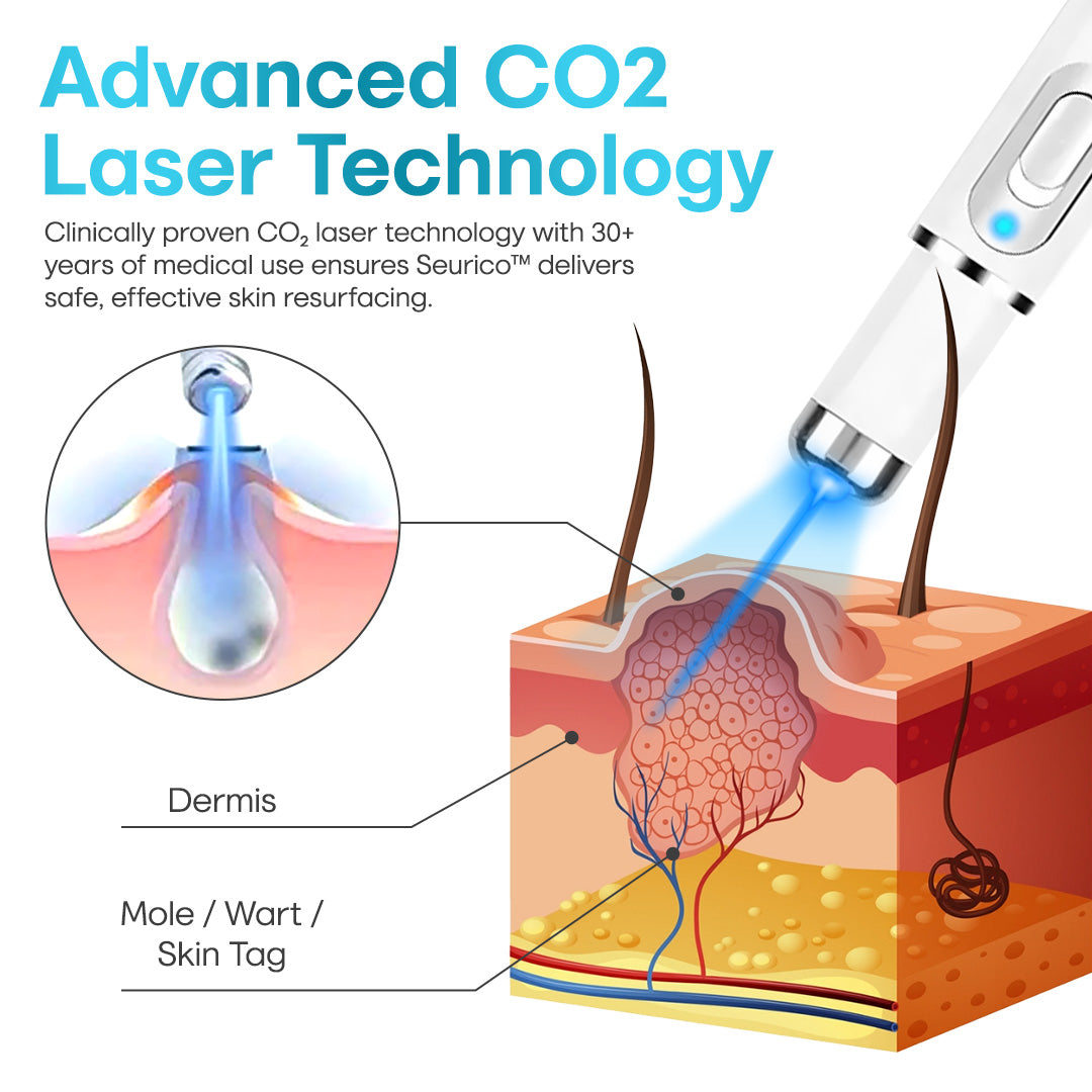 Seurico™ Laser Pen – Non-Invasive Mole and Wart Removal 1–3 days