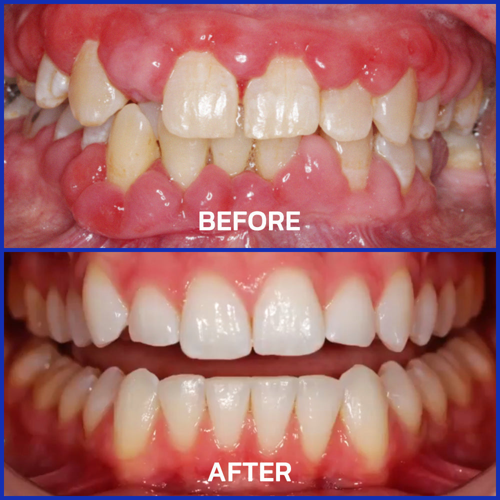 Odeiun™ Bee Venom Gum Repair Powder 🐝 (ADA Approved) 🎁 Flash Sale – Restore Teeth & Gums Now!