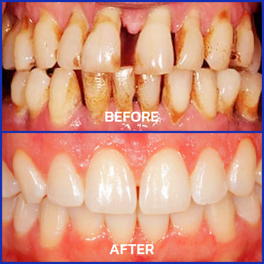 Odeiun™ Bee Venom Gum Repair Powder 🐝 (ADA Approved) 🎁 Flash Sale – Restore Teeth & Gums Now!