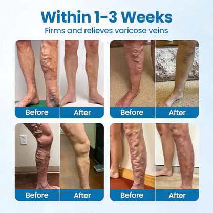 🎁 ODEIUN™ VeinGuard Herbal Spray – ✅ Clinically Proven to Erase Varicose Veins in Just 7 Days!