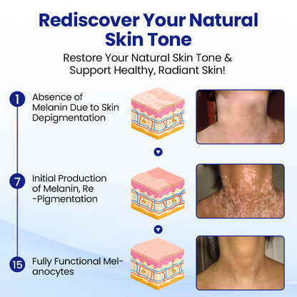 ODEIUN™ Vitiligo Treatment Spray 🌿 Fade Spots Restore Confidence 🌞