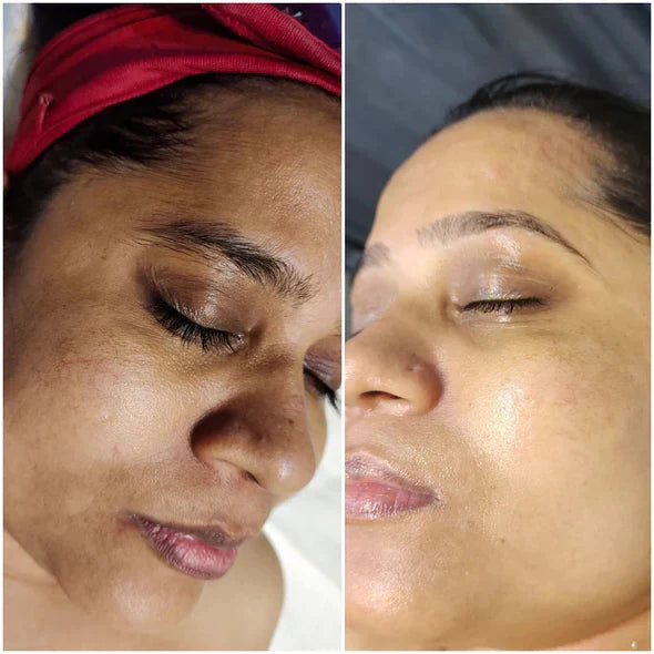 ✨Seurico™ Rapid Dark Spot Eraser – Melanin Correcting Facial Serum🔥