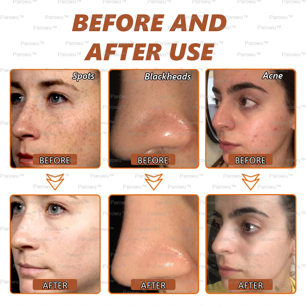 🏵️ Zakdavi™ Whitening and Spot-Removing Face Mask Suitable for face and body – 👩‍⚕️ Natural ingredients permanently remove age spots, freckles, sun spots, and liver spots.