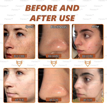 🏵️ Zakdavi™ Whitening and Spot-Removing Face Mask Suitable for face and body – 👩‍⚕️ Natural ingredients permanently remove age spots, freckles, sun spots, and liver spots.