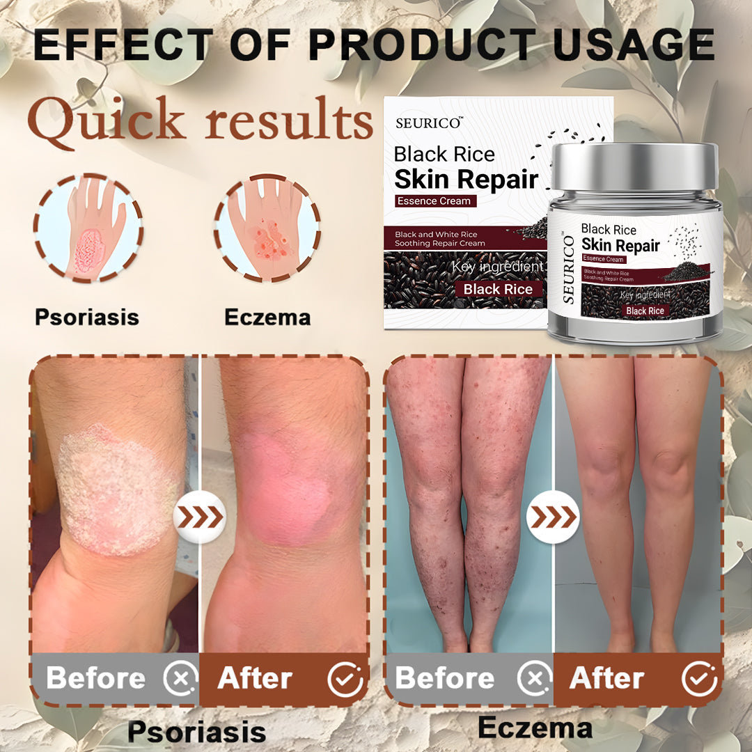 Seurico™ Black Rice Skin Repair Cream ⚕️ FDA Certified – Targets Warts, Psoriasis & Pigmentation