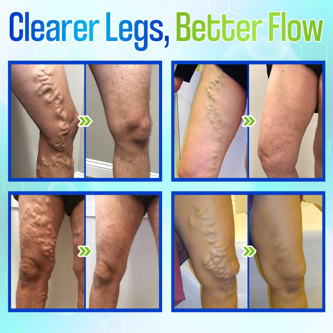 🎁 ODEIUN™ VeinGuard Herbal Spray – ✅ Clinically Proven to Erase Varicose Veins in Just 7 Days!