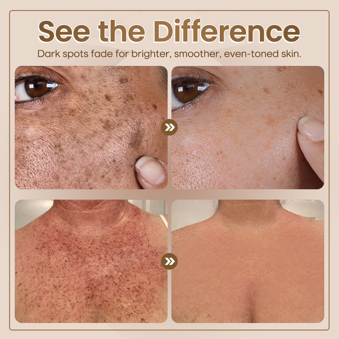 ✨Seurico™ Rapid Dark Spot Eraser – Melanin Correcting Facial Serum🔥