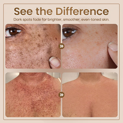 ✨Seurico™ Rapid Dark Spot Eraser – Melanin Correcting Facial Serum🔥