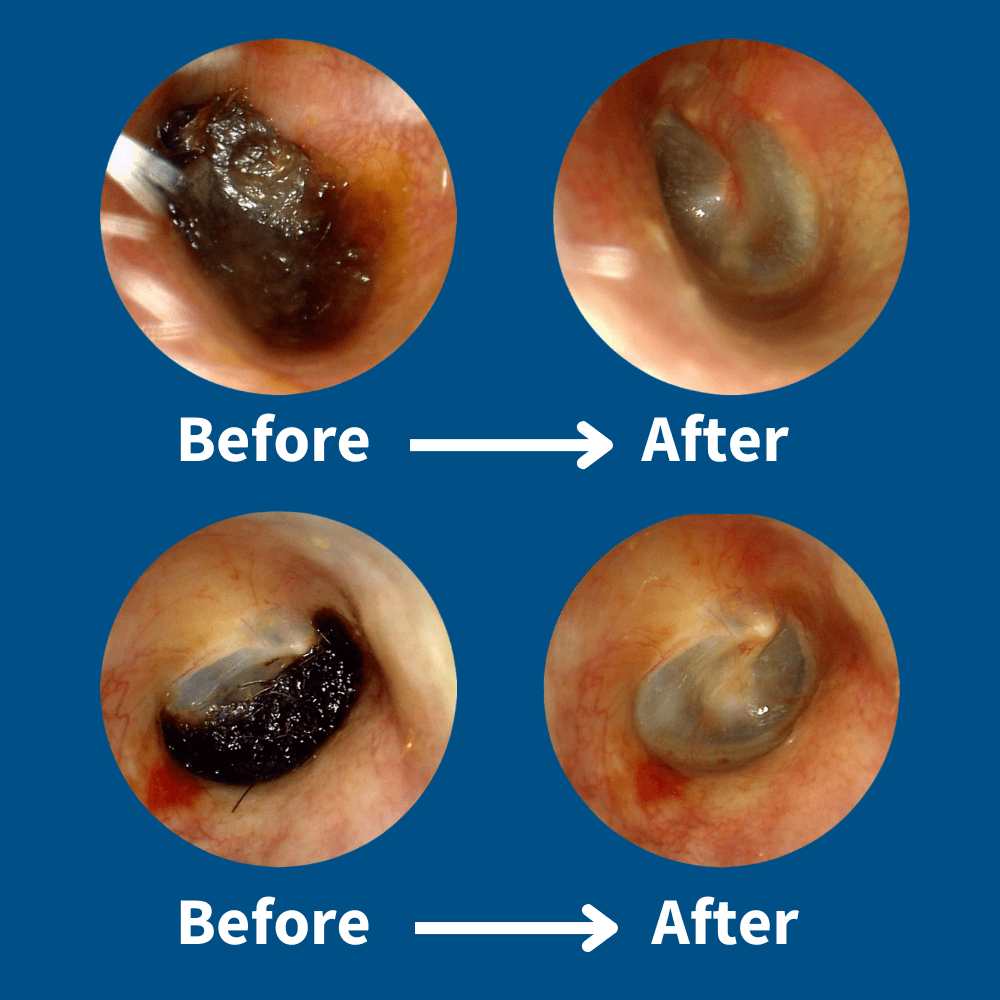 Zakdavi™ ProClean Earwax Removal Tool